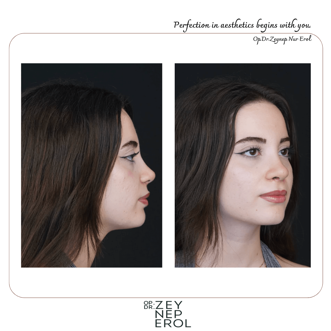 Esthétique Nasale - Rhinoplastie