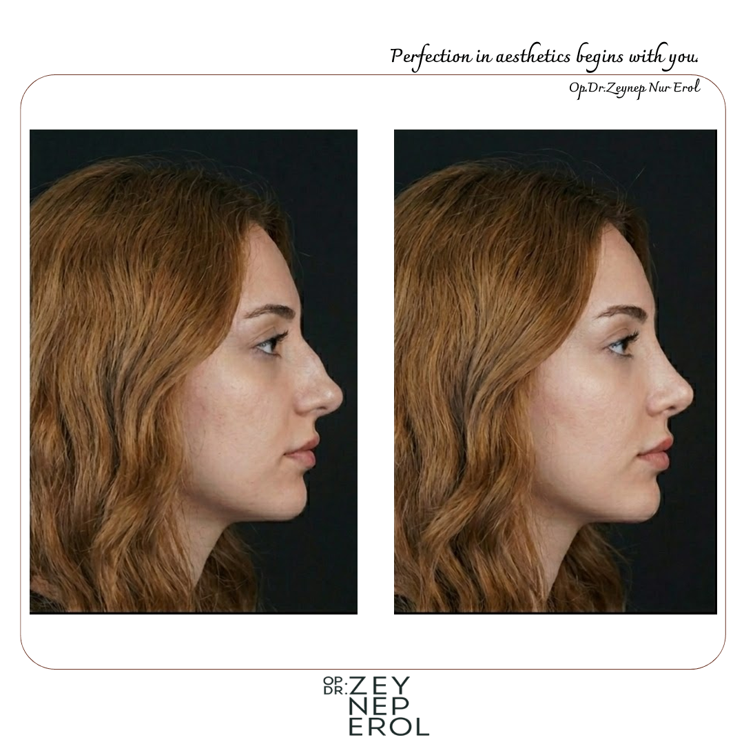 Rhinoplastie de Révision